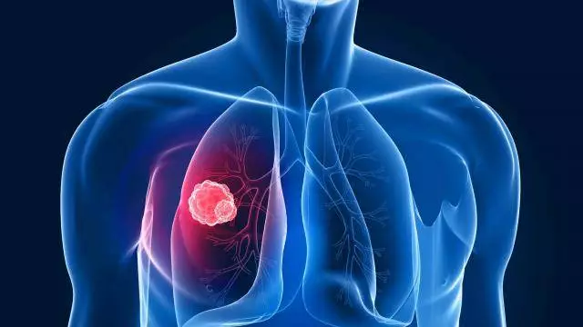 Cancer-pulmonar-300x169 Cancer pulmonar