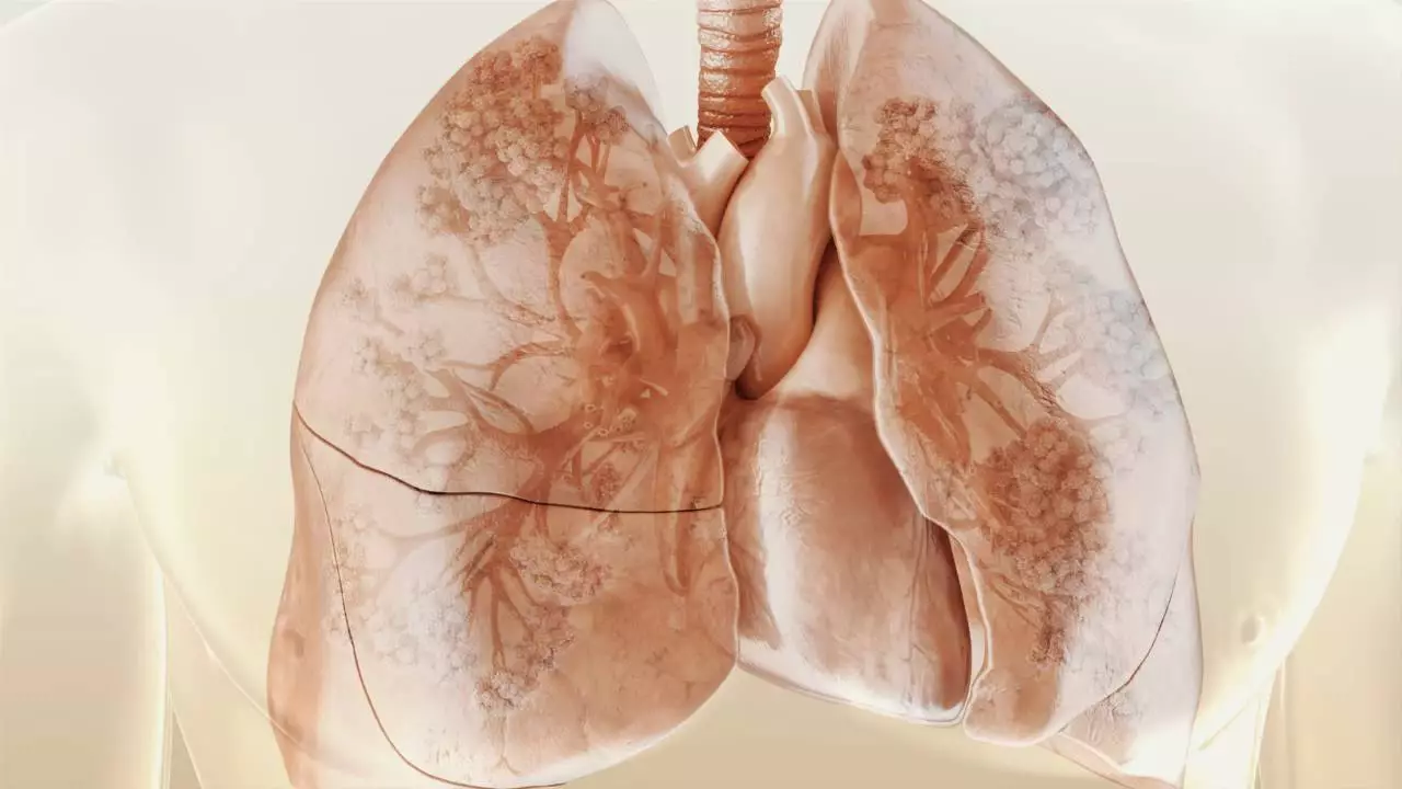 Fibroza-pulmonara-300x169 Fibroza pulmonara