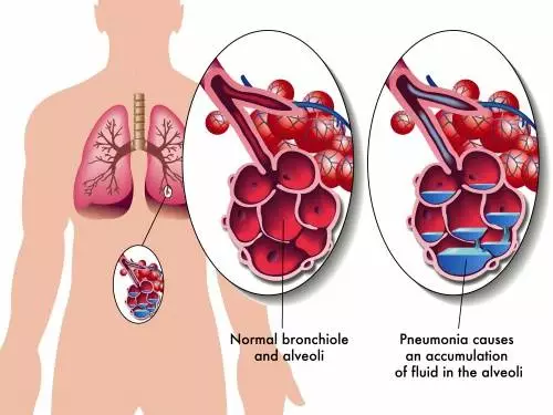 Pneumonie-Aprindere-la-Plamani-300x225 Pneumonie Aprindere la Plamani