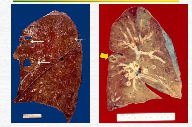 Abces-pulmonar Abces pulmonar
