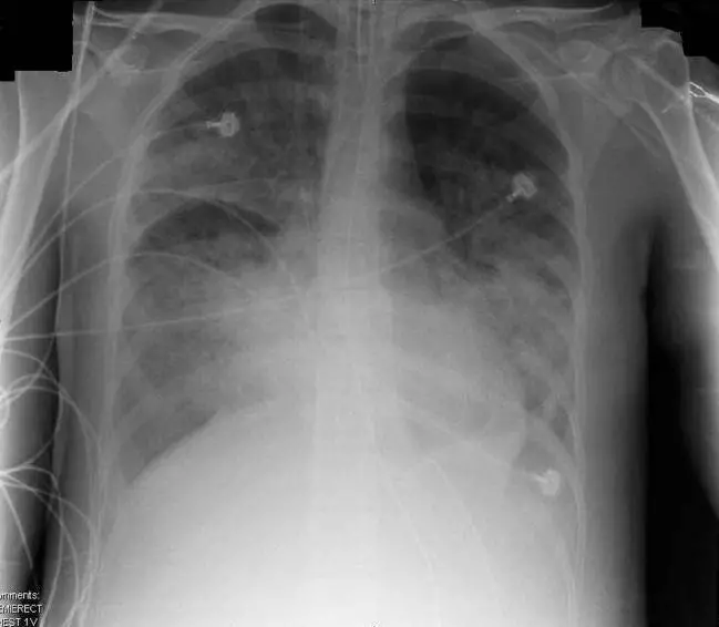 Boli-pulmonare-300x262 boli-pulmonare